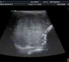 Zašto ultrazvuk štitnjače i to pokazuje