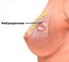 Fibroadenom dojke - što je to i kako da biste dobili osloboditi od njega?