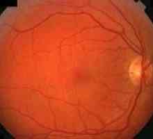 Pozadina retinopatija oka