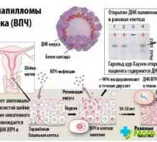 Fotografije ljudski papiloma virus kod žena - poticaj za akciju