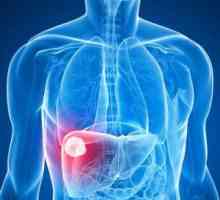 Hemangioma jetre: pojave simptoma, kako se postupa, prognozu