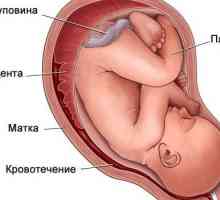 Hematom u maternici za vrijeme trudnoće