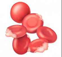 Hemolitička anemija: uzroci, vrste, simptomi, dijagnoza, liječenje