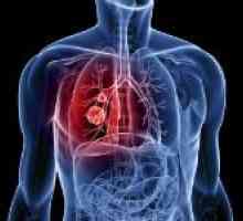 Simptomi plućne krvarenja i prva pomoć