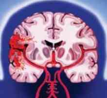 Hemoragijski moždani udar: vrste, simptomi, dijagnoza, liječenje, faktori rizika