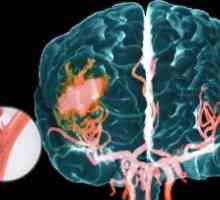Hemoragijski moždani udar: klinička obilježja i dijagnoza