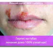 Herpes na usnama - tretman od 100% kod kuće kako bi saznali kako!
