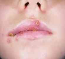 Herpes na usnama u djece