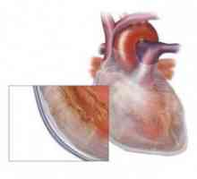Hydropericardium: izgled, simptomi, oblik (mali, izrazio) za liječenje