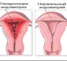 Hiperplazija endometrija: liječenje lijekovima i narodnih lijekova
