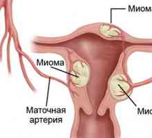 Hiperplazija karcinom endometrija