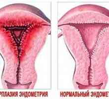 Hiperplazija endometrija za vrijeme menopauze