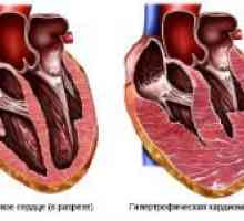 Hipertrofična kardiomiopatija u djece i odraslih
