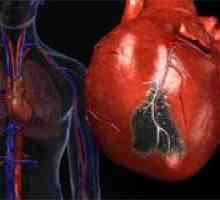 Glavni razlozi za opsežne infarkta miokarda