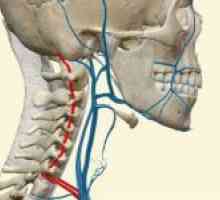 Hipoplazija od vertebralnih arterija