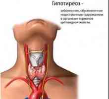 Hipotireoza. Simptomi i liječenje
