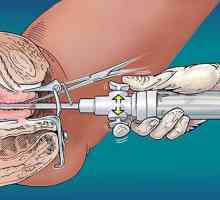 Histeroskopija maternice: istraživanje o definiciji bolesti