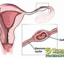 Glavne značajke modernog dijagnostici izvanmaterične trudnoće