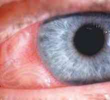 Očni toxocariasis: simptomi, dijagnoza, liječenje