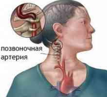 Glavobolja u osteochondrosis vrata