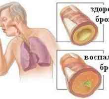 Kronični bronhitis je razlog zašto „donosi dyhalki”?