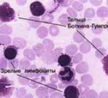 Kronična leukemija krv
