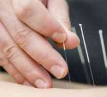 Akupunktura - stoljetni iskustvo tradicionalne orijentalne medicine