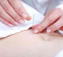 Akupunktura pomaže da izgubite težinu