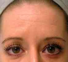 Botox protiv bora na čelu