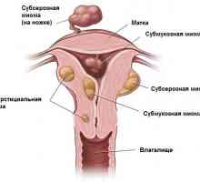 Međuprostorne fibroidi maternice