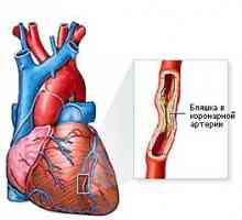 Koronarna bolest srca (CHD)