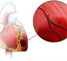 Ishemijske kardiomiopatije