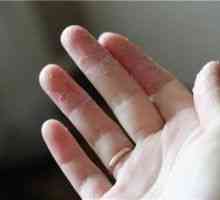 Koji je razlog zašto je koža ljušti na rukama?