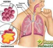 Lijek pneumonija narodnih lijekova kod kuće