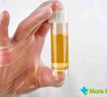 Svijetle žute boje urina: uzroci bolesti i mogućim komplikacijama