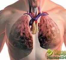 Učinkovito liječenje plućne fibroze narodnih lijekova