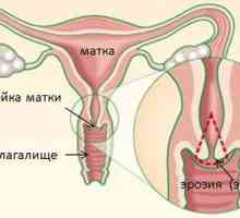 Uzrok vrata maternice endocervicosis i tretmani