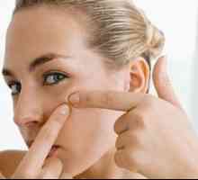 Učinkovit i jeftin akne krema na licu - što tražiti?