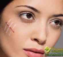 Učinkoviti recepte tradicionalne medicine u liječenju ožiljaka