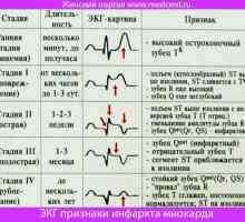 EKG znakova infarkta miokarda. Slike i objašnjenja