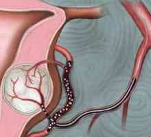 Embolizacija od miom maternice arterija: dokazi, postupak, rezultati