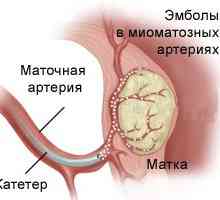 Embolizacija maternice mioma