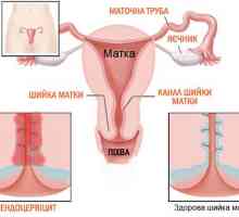 Vrata maternice Endocervicitis