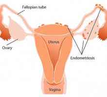 Simptomi endometrioza maternice i liječenje