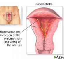 Endometrioza - kakav infekcije i kako ga liječiti?