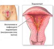 Endometrioza i endometrioze - u skladu s imenom, ali različitih dijagnoza