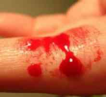 Kako zaustaviti krvarenje kapilara