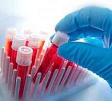 Kako i zašto sam trebao donirati test krvi za toksoplazmoza