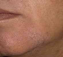 Kako da biste dobili osloboditi od seboroičnog dermatitisa na licu? Mi utvrditi uzrok bolesti.