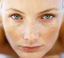 Kako da biste dobili osloboditi od freckles
